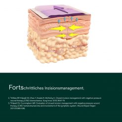 prevena-plus-customizable-dressing-pdp-secondary-image-1-ms-aw-de