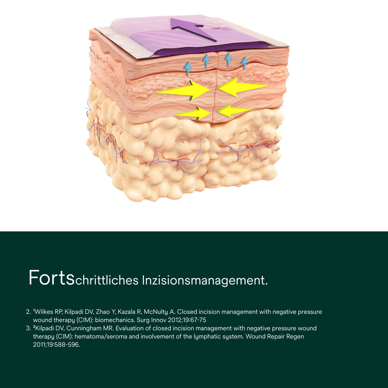 prevena-plus-customizable-dressing-pdp-secondary-image-1-ms-aw-de